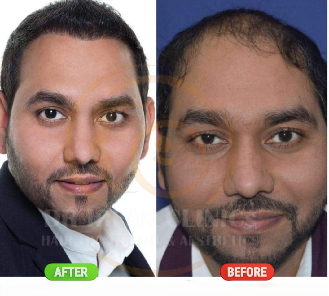 Hair Transplant Results Timeline